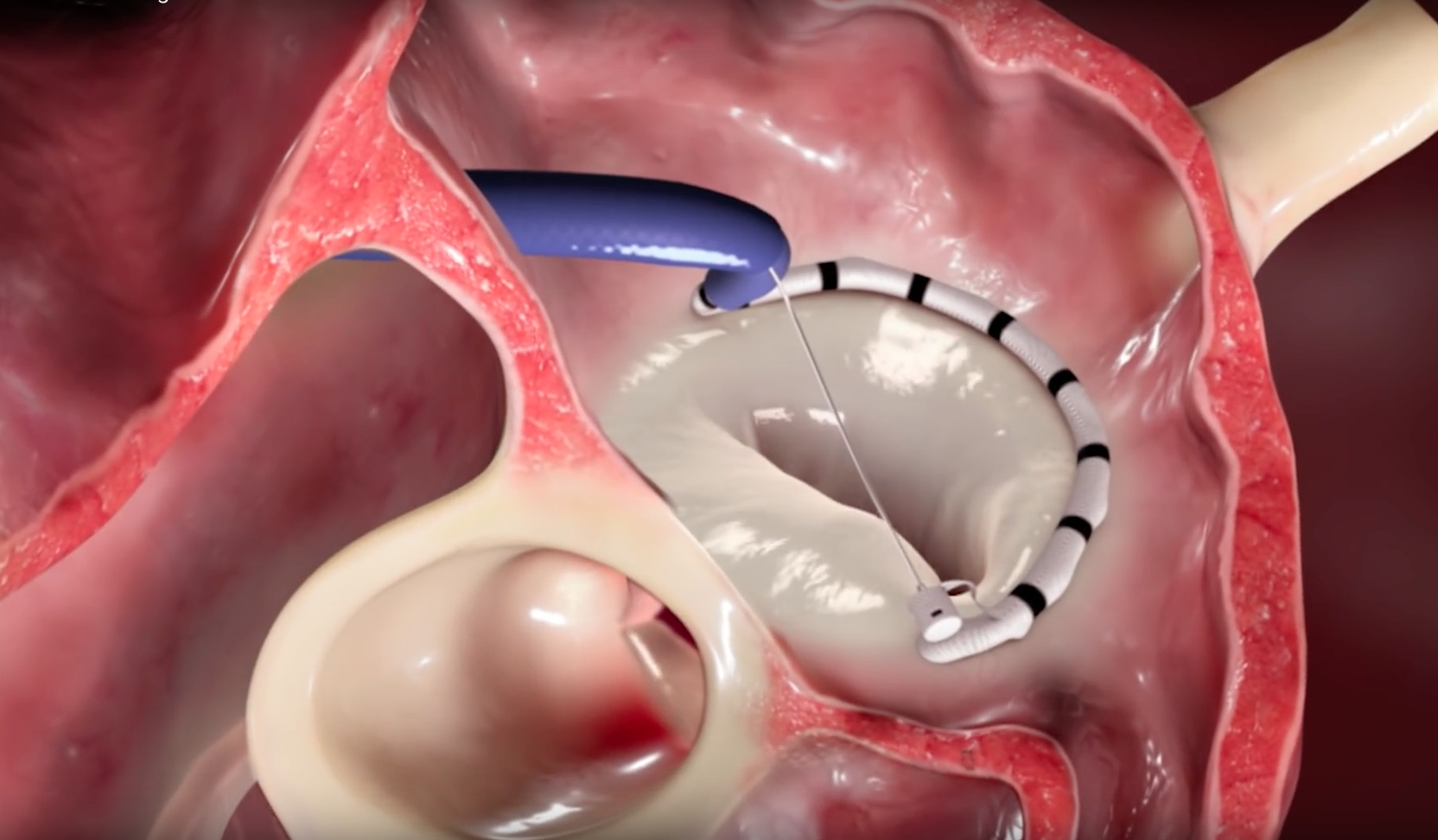 Edwards To Acquire Transcatheter Mitral, Tricuspid Valve